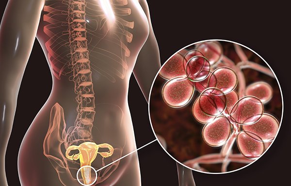 DIAGNÓSTICO Y TRATAMIENTO ACTUAL DE LAS INFECCIONES GENITALES EN LA PRÁCTICA GINECOLÓGICA